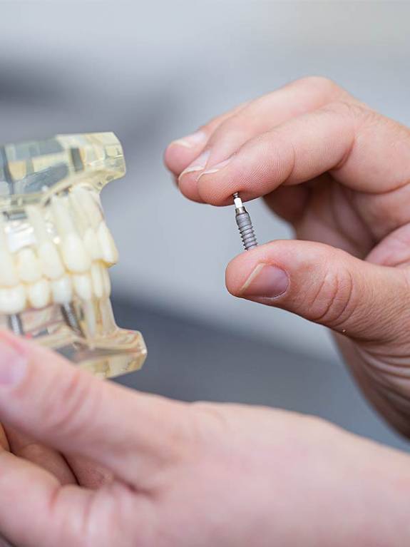 Detailansicht einer Implantatschraube